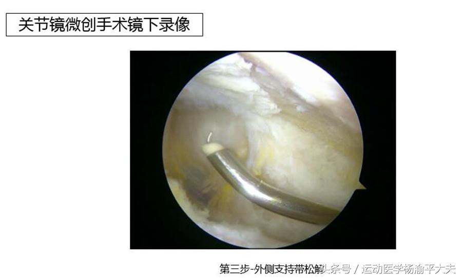 上下楼膝关节疼痛最好治疗方法,膝关节疼痛怎样上下楼能缓解疼痛