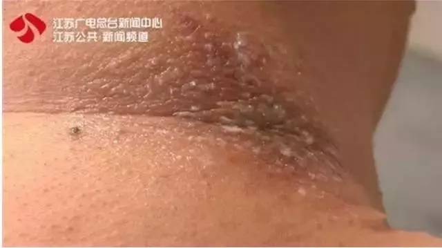 蚊子皮肤细菌感染溃烂,蚊虫叮咬可以拍吗