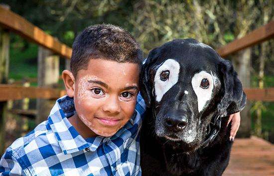 如何分辨白癜风的治愈率,白癜风泛发性和局部性怎么分辨