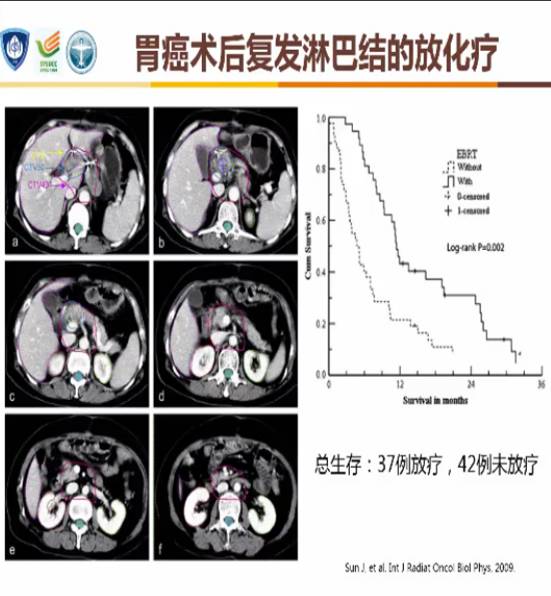2023版csco胃癌诊疗指南分子检测,2024csco胃癌诊疗指南