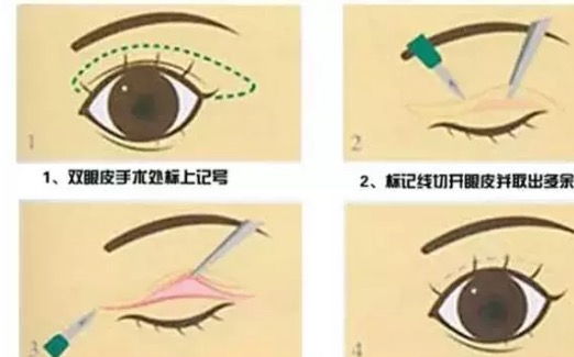 做双眼皮一个星期后感觉太宽了,第一次做双眼皮太窄了