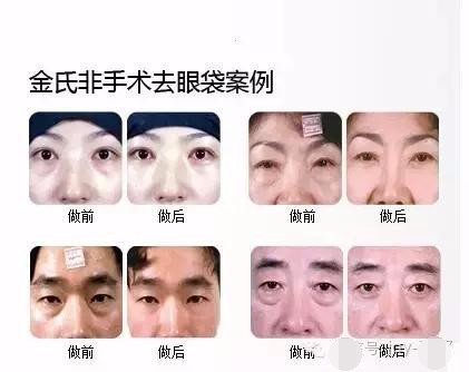 抢救假性眼纹、眼袋的黄金时间，错过你就老了