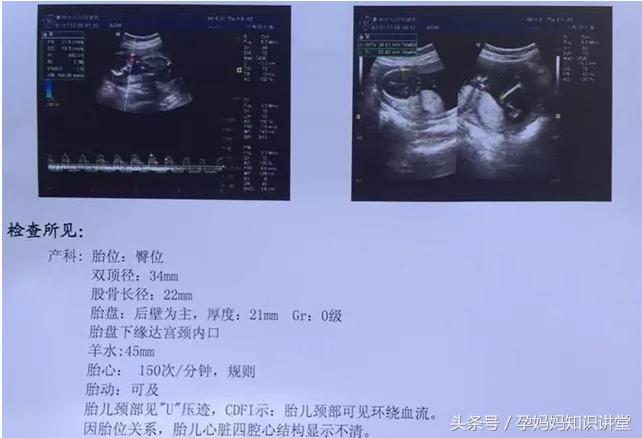 怎么看b超单判断胎儿怀孕,早孕b超图怎么看出胎儿性格