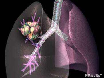 胸腔积液怎么治才能除根,胸腔积液怎么治才能彻底除根