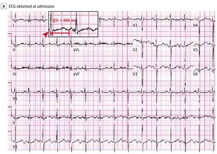 胺碘酮治什么病,胺碘酮这个药是治疗什么的