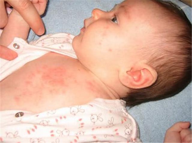 新生儿干性湿疹和湿性湿疹的区别,新生儿宝宝湿疹要怎么治疗