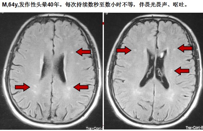 遇到前庭性偏头痛怎么办？如何治疗和鉴别？最详尽视频送给你