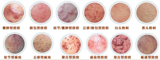 扰人的痘痘问题,你都可以解决!