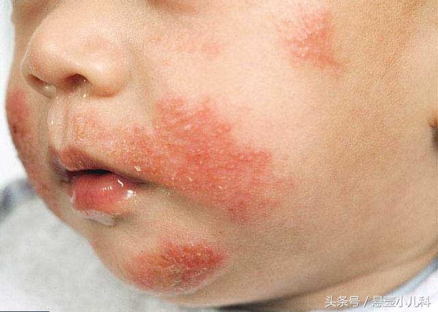 去看湿疹医生开了一大堆药,在医院给孩子看湿疹的经历