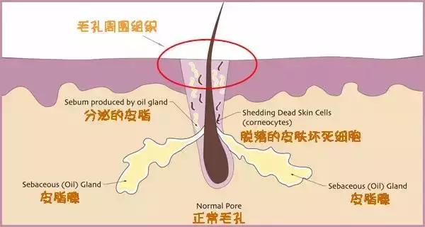 为什么你的毛孔会又黑又大,毛孔粗大怎么办方法其实很简单