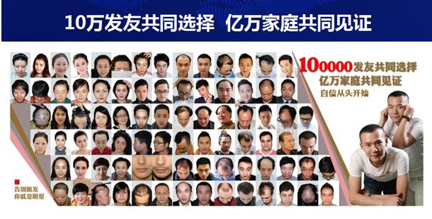 济南遗传性脱发植发效果如何,脂溢性脱发遗传性脱发植发有用吗