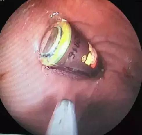 2岁男童误吞电池要做手术，急诊医生居然拿出导尿管！