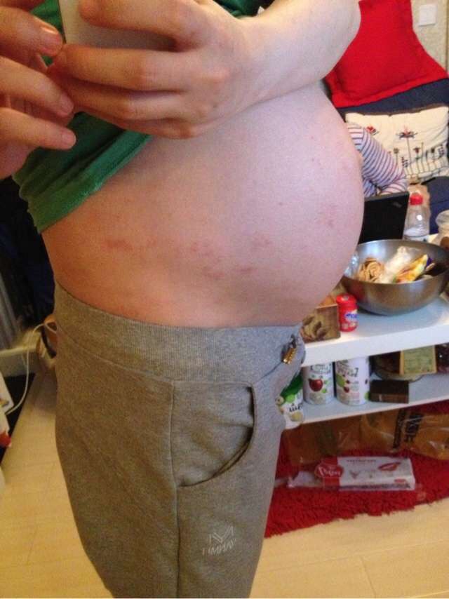 孕妈湿疹用什么外用药,孕期湿疹宝妈