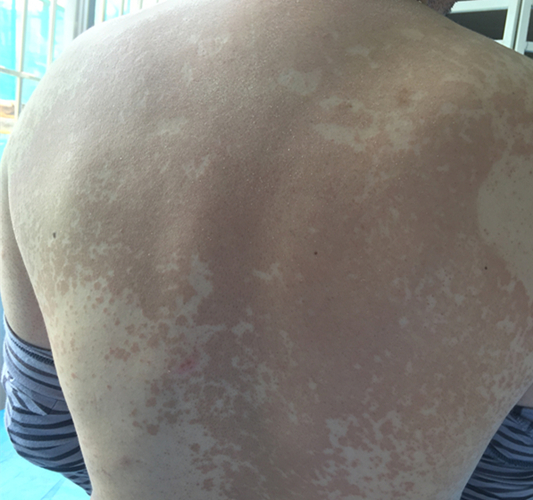 小孩身上有一块白斑怎么回事,天冷身上会有白斑什么情况