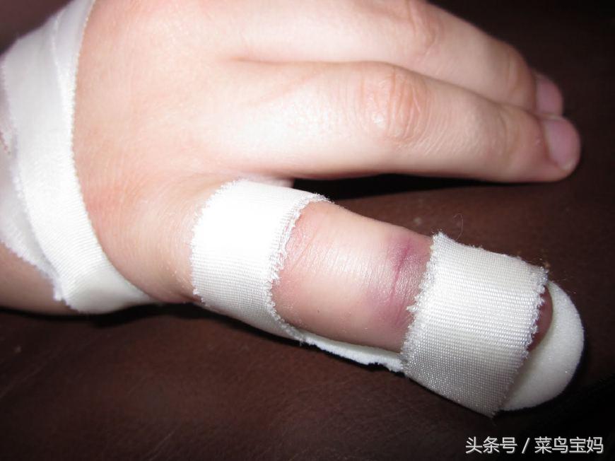 婴儿头部被产道夹伤有哪些损伤,婴儿被月嫂摔伤