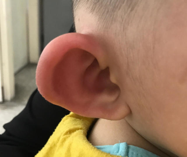 腿上被蚊子咬了留下的疤痕怎么祛,冬天宝宝腿上起疙瘩像是蚊子咬的