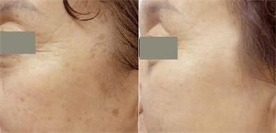 老年斑是怎么形成的如何消除,怎样预防老年斑及去除老年斑