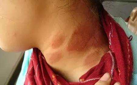 湿疹皮肤用药大全手册,湿疹性皮炎宣教