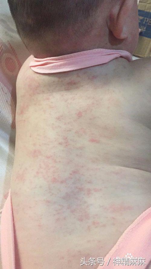 怎么区分热痱子湿疹过敏,夏天起痱子是和荨麻疹过敏有关吗