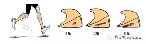 健身半月板疼怎么回事,健身房爬坡会造成半月板损伤吗