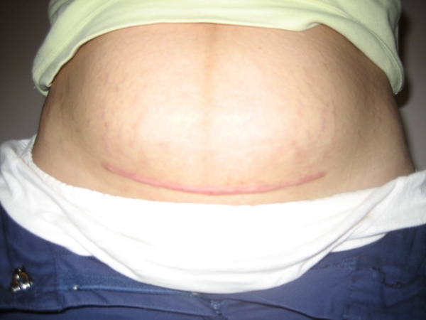 学剖腹产基本操作,剖腹产第一节课