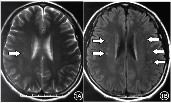 遇到前庭性偏头痛怎么办？如何治疗和鉴别？最详尽视频送给你