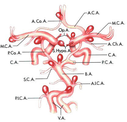 动脉瘤介入栓塞和开颅的风险评估,发现颅内动脉瘤需要治疗吗