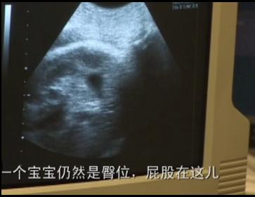 孕妇剖腹生下双胞胎惊呆医生,双胞胎出生过程实录