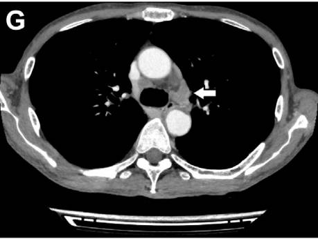 腹泻的不同类型及病例,腹泻的不同原因及现象
