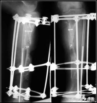 胫骨骨折骨缺损多大可以自愈,胫骨骨折有小块骨缺损影响吗