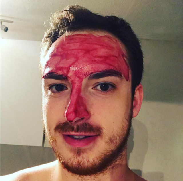 怎样才能祛痘去黑头去闭口,祛痘去黑头粉刺闭口