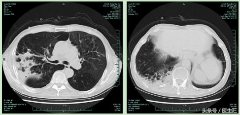 男性78岁慢性咳嗽气喘30余年,40岁男子持续咳嗽咳痰10多年