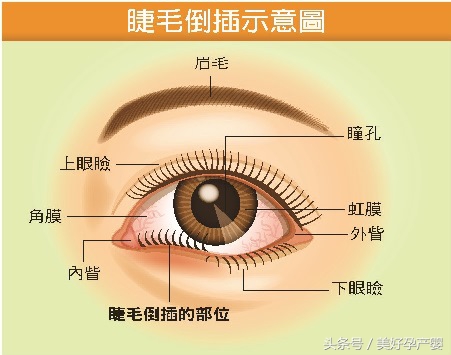 宝宝倒睫毛什么时候长好,宝宝倒睫毛是不是经常眨眼