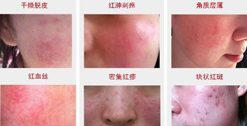 如何判断激素依赖性皮炎,怎样证明激素脸过了戒断期