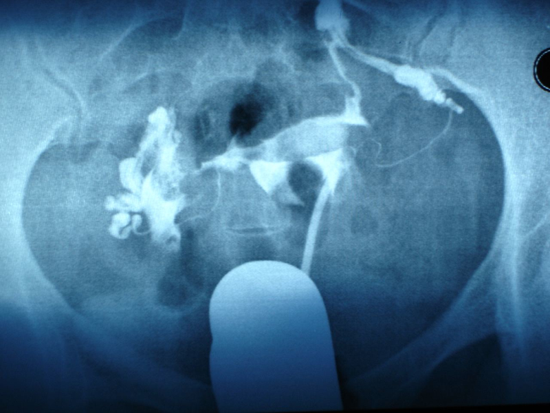 胎盘如果不自动流出,医生会怎么办?这个过程比生孩子更痛苦!