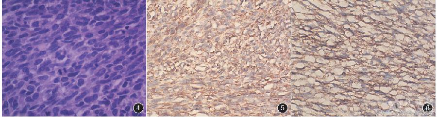 女子腰痛查出两种癌,女子看腰痛意外查出肺癌