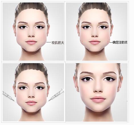 一针变二针加针方法,变成v脸方法