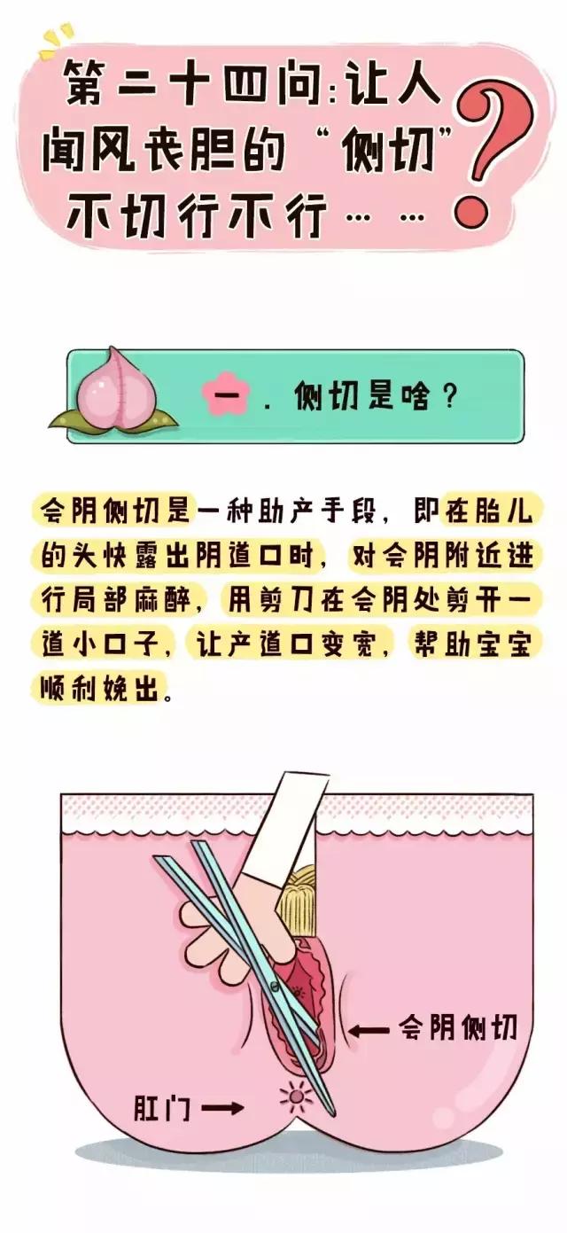 哪种情况需要侧切,侧切到底该不该做