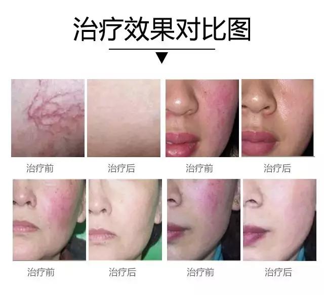 脸上红血丝多治红血丝的最佳方法,红血丝怎么拯救
