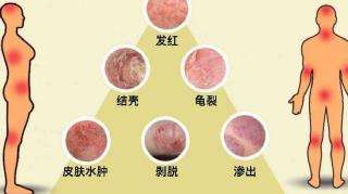 新生儿湿疹怎么预防,怎么预防新生儿湿疹