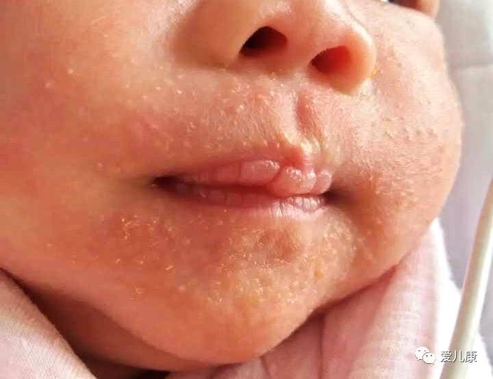 小孩一次性吃了20维生素ad,维生素ad滴剂宝宝一次误吃了20颗