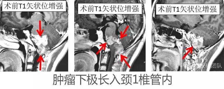 喝水容易呛是怎么回事是肺癌,老人喝水容易呛咳怎么办