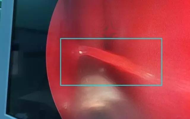 打喷嚏突然大量鼻血止不住,成人打喷嚏流鼻血流不停