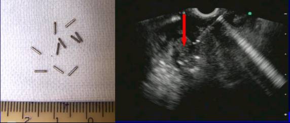 超声内镜检查是什么意思,超声内镜一般多少钱