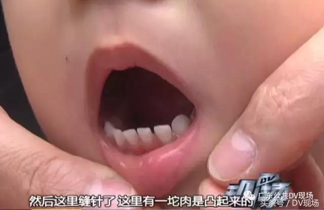 孩子从滑滑梯摔倒头上怎么办,3岁小孩玩冰滑梯摔伤