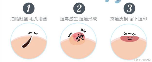 一痘毁所有十招还你平滑肌肤,一痘毁所有5个祛痘小技巧