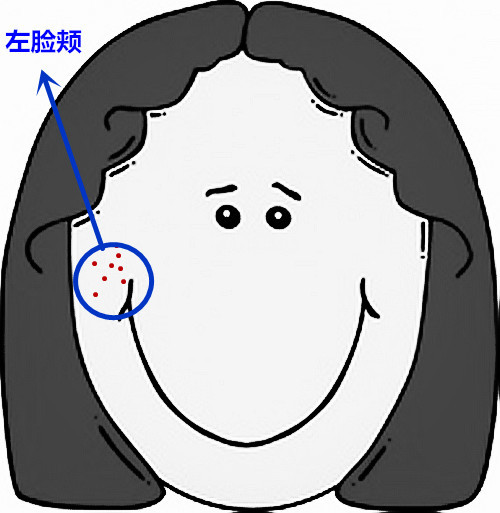 面部痘痘的症状图片和讲解,面部痘痘原因分析图片