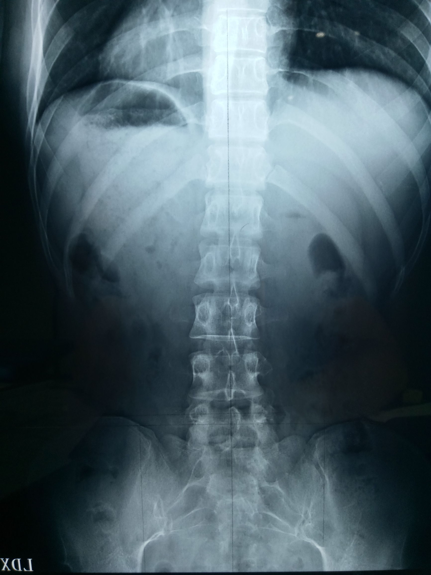 脊椎变形可以自行矫正,脊椎变形矫正视频