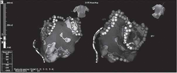 什么样的房颤需要抗凝治疗,房颤是药物治疗好还是手术治疗好