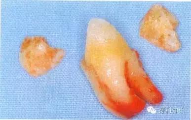 口腔拔牙图片,口腔拔牙麻醉多久消退